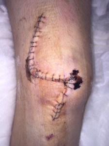 Michael's Knee after the Op!